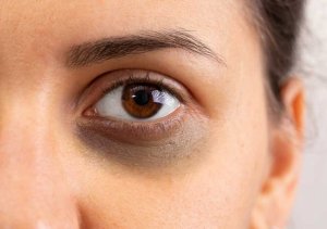 Evde göz altı torbaları nasıl geçer? Göz torbalarına en iyi gelen şey nedir?