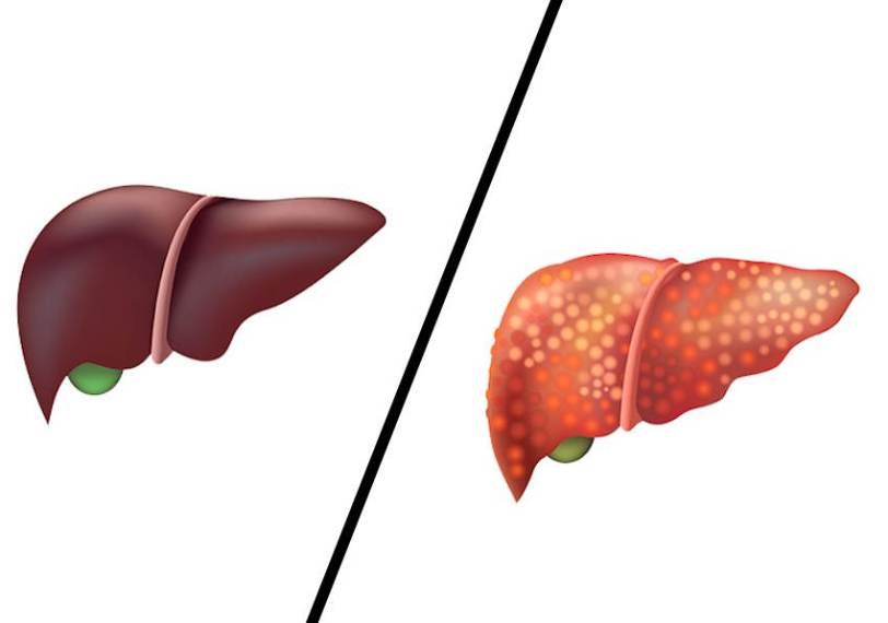 Karaciğer Yağlanmasına İyi Gelen Bitkiler: Doğal Çözümlerle Sağlığınızı Koruyun