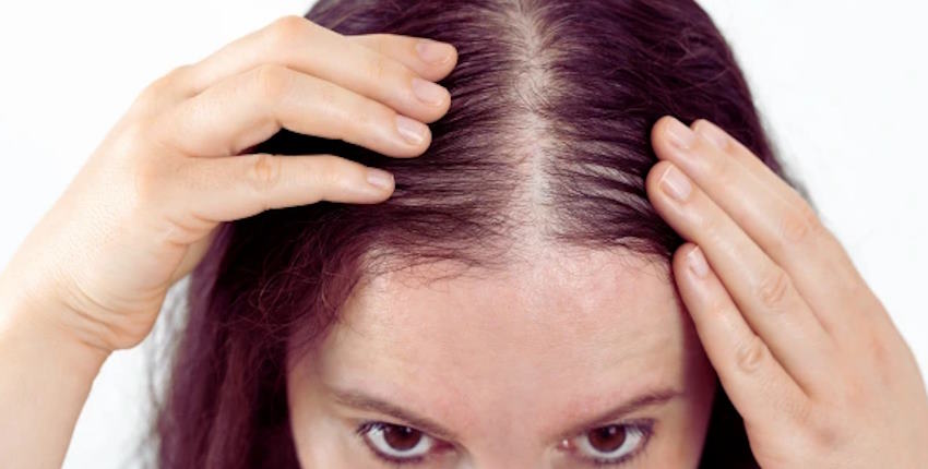 How to treat hair loss in women?