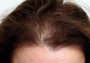 Bayanlarda Saç Dökülmesine Ne İyi Gelir? En Etkili Çözümler ve Öneriler